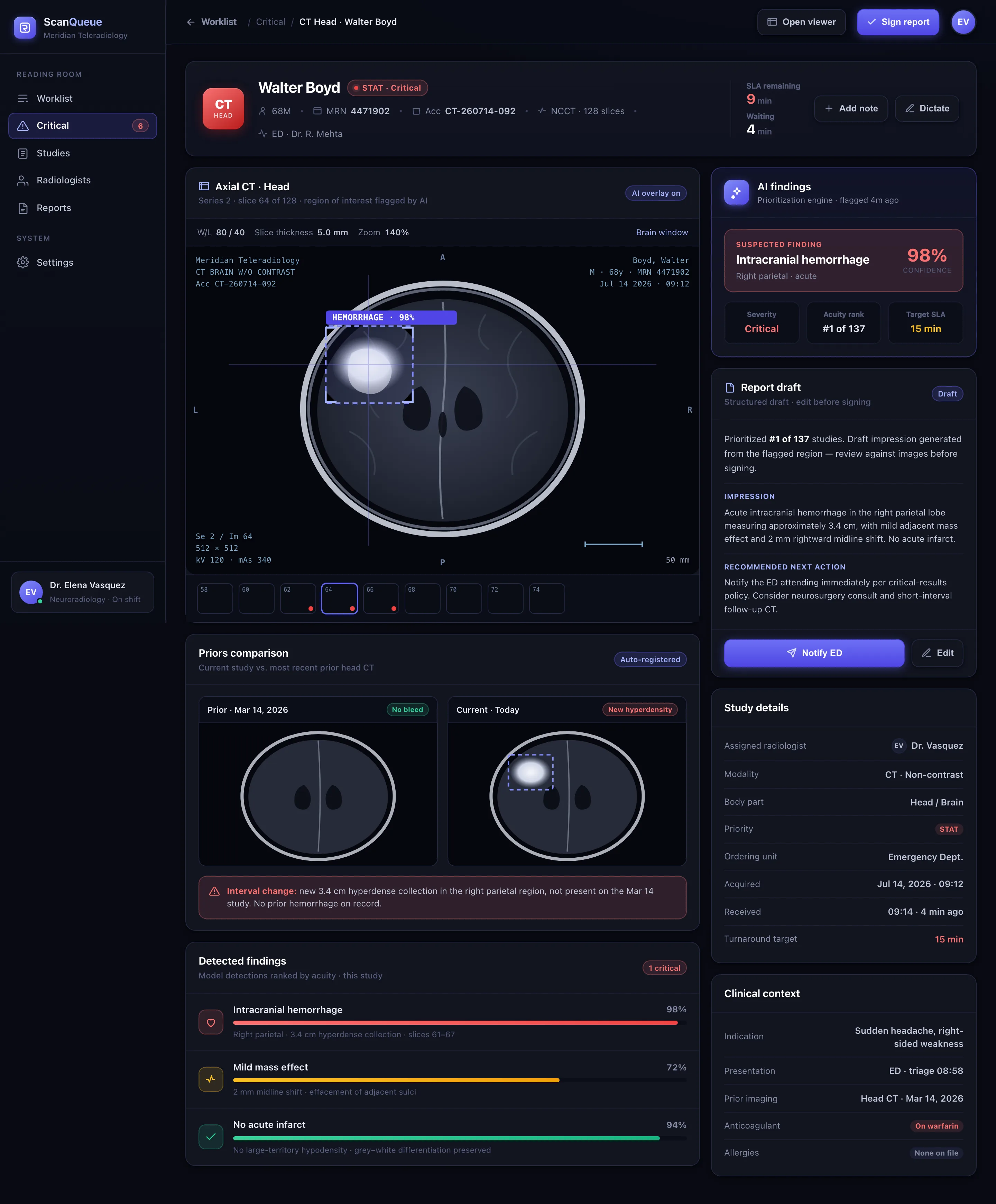 ScanQueue study detail: an axial CT head with an AI bounding box on a suspected hemorrhage, a priors comparison, detected findings with confidence bars, and a report draft with a recommended next action